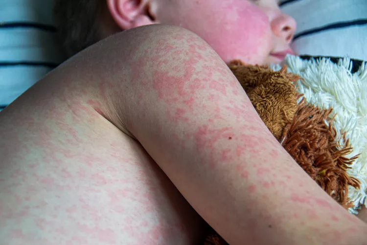 Health workers reviewing measles vaccination records and response measures near Panama's border region